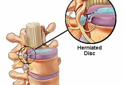 cervical-herniated-disc-overview