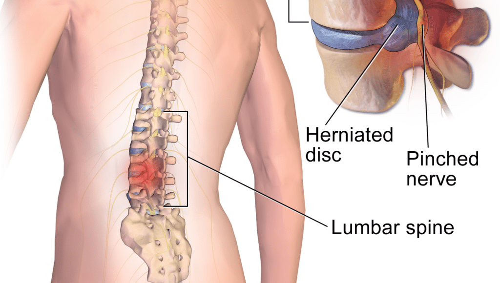 Lumbar Herniated Disc - Summary of Symptoms, Diagnosis, and Treatment