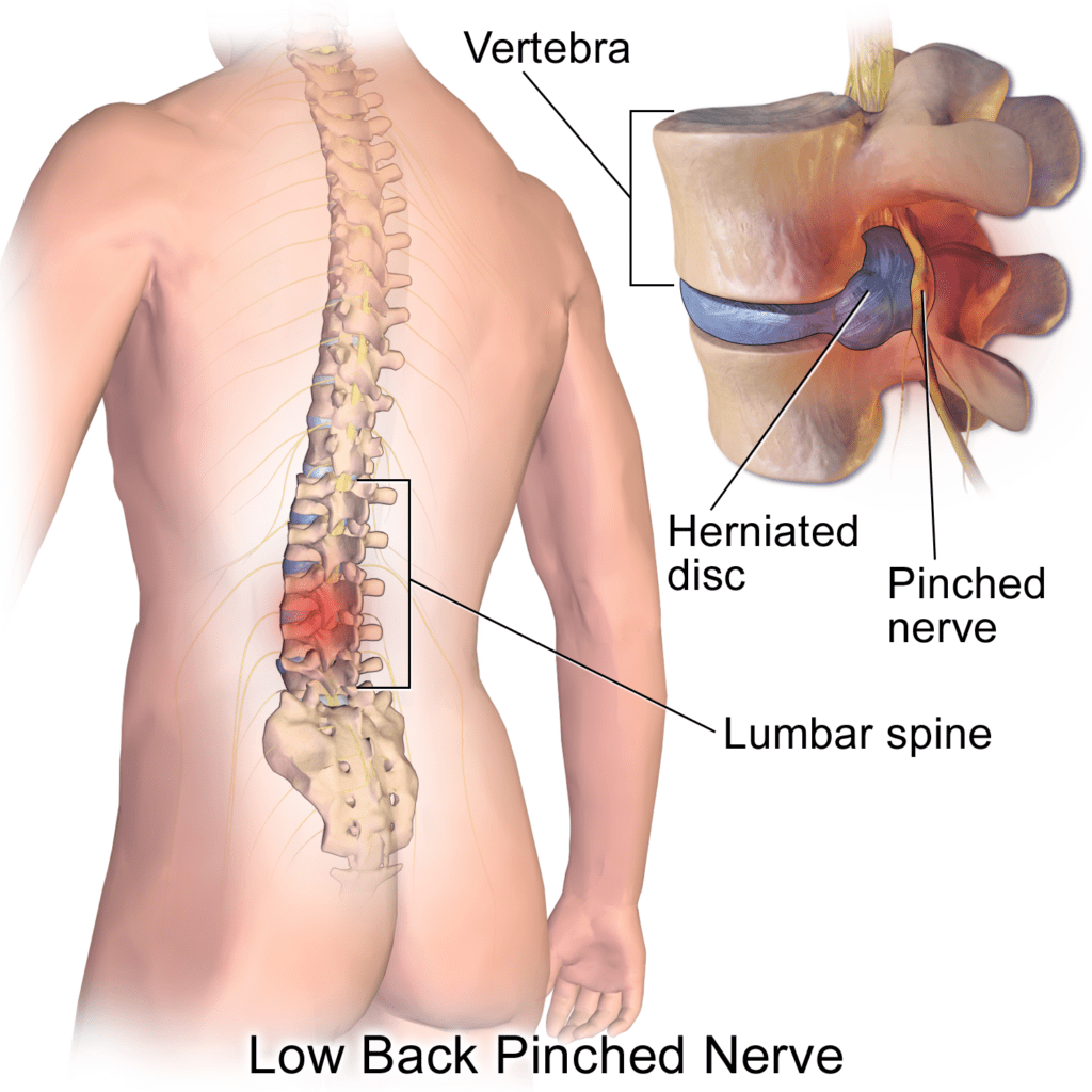 Lumbar Herniated Disc - Summary of Symptoms, Diagnosis, and Treatment