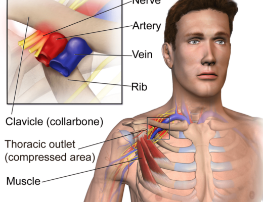 Thoracic Outlet Syndrome: Summary of Symptoms, Diagnosis, & Treatment