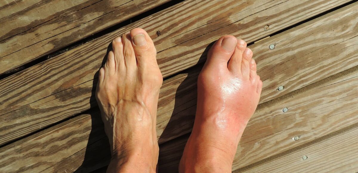 CBD Oil for Gout (Explore How it Works)