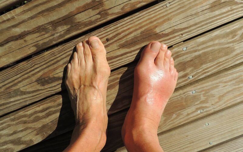 CBD Oil for Gout (Explore How it Works)